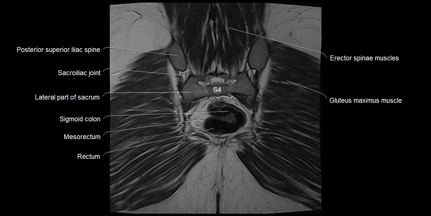 female pelvis coronal cross sectional anatomy image 33.webp